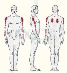 Trigger points on the Infraspinatus muscle can cause pain in down till the wrist